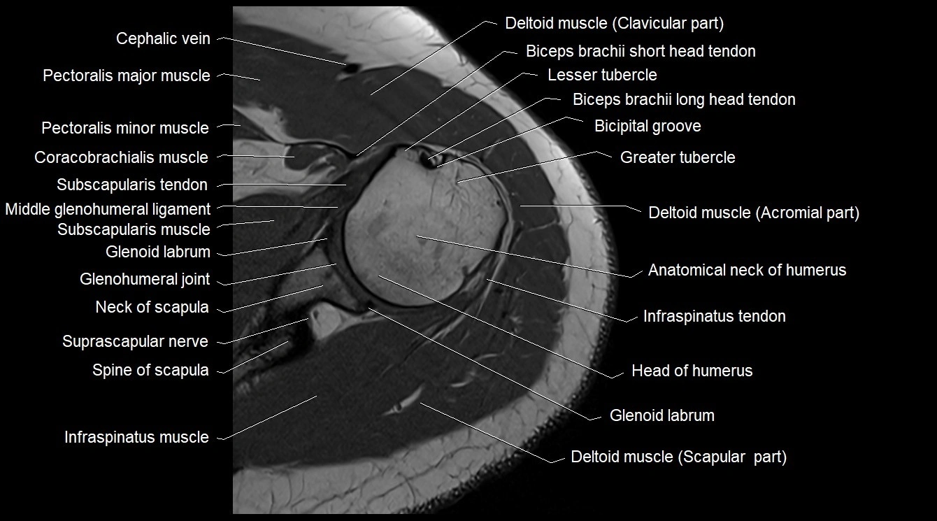 Upper arm( humerus) cross section anatomy MRI 3T axial image 11.webp